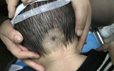 一岁幼儿头皮惊现吸血蜱虫，紧急应对与安全防范指南